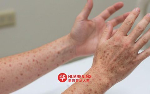 科阿韦拉州报告4例麻疹病例