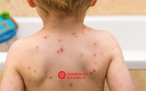 新莱昂州新增5例麻疹病例，累计确诊达25例