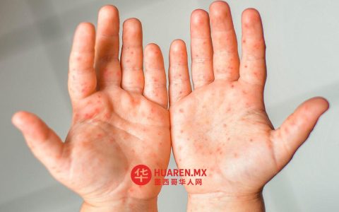 哈利斯科州确诊第10例麻疹病例