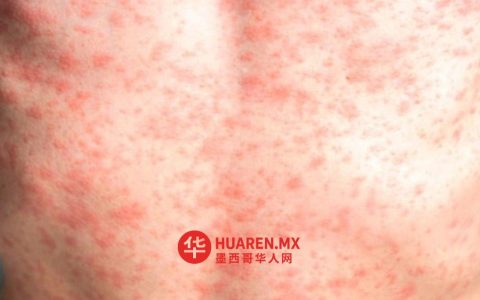 哈利斯科州麻疹病例占全国56%，医疗界呼吁紧急应对