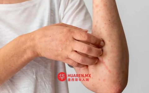 墨西哥卫生部发布麻疹疫情警报