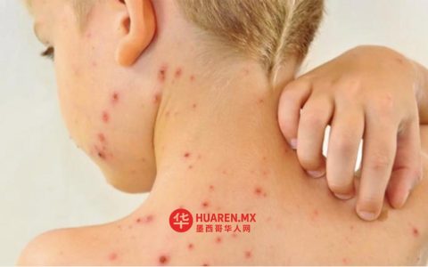 杜兰戈州麻疹病例增至17例